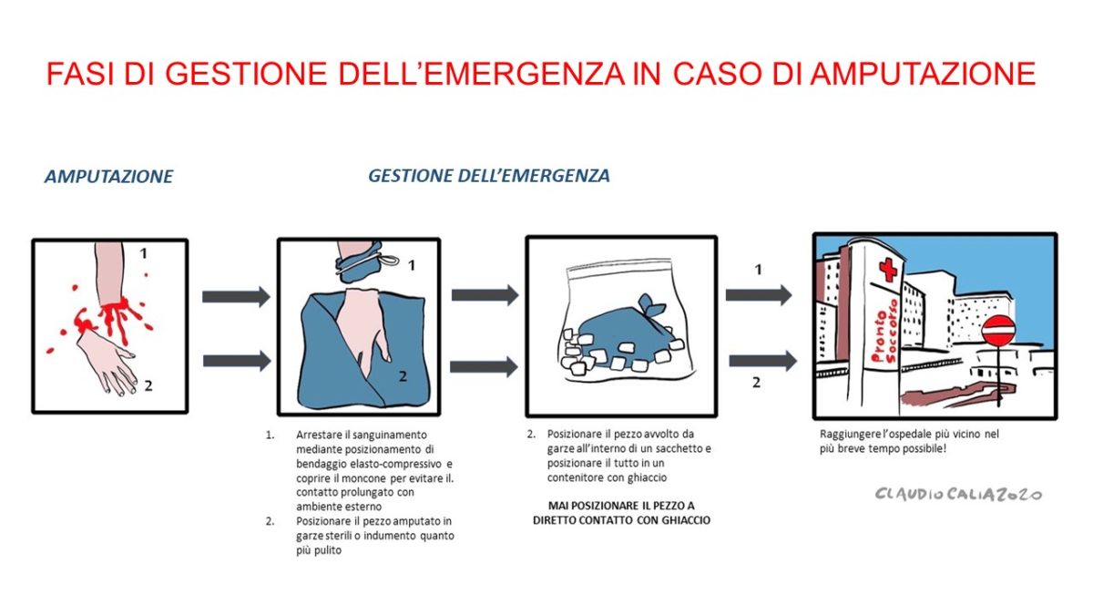 disegni-amputazione-mano